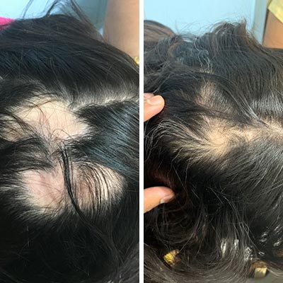 Alopecia / Hair loss